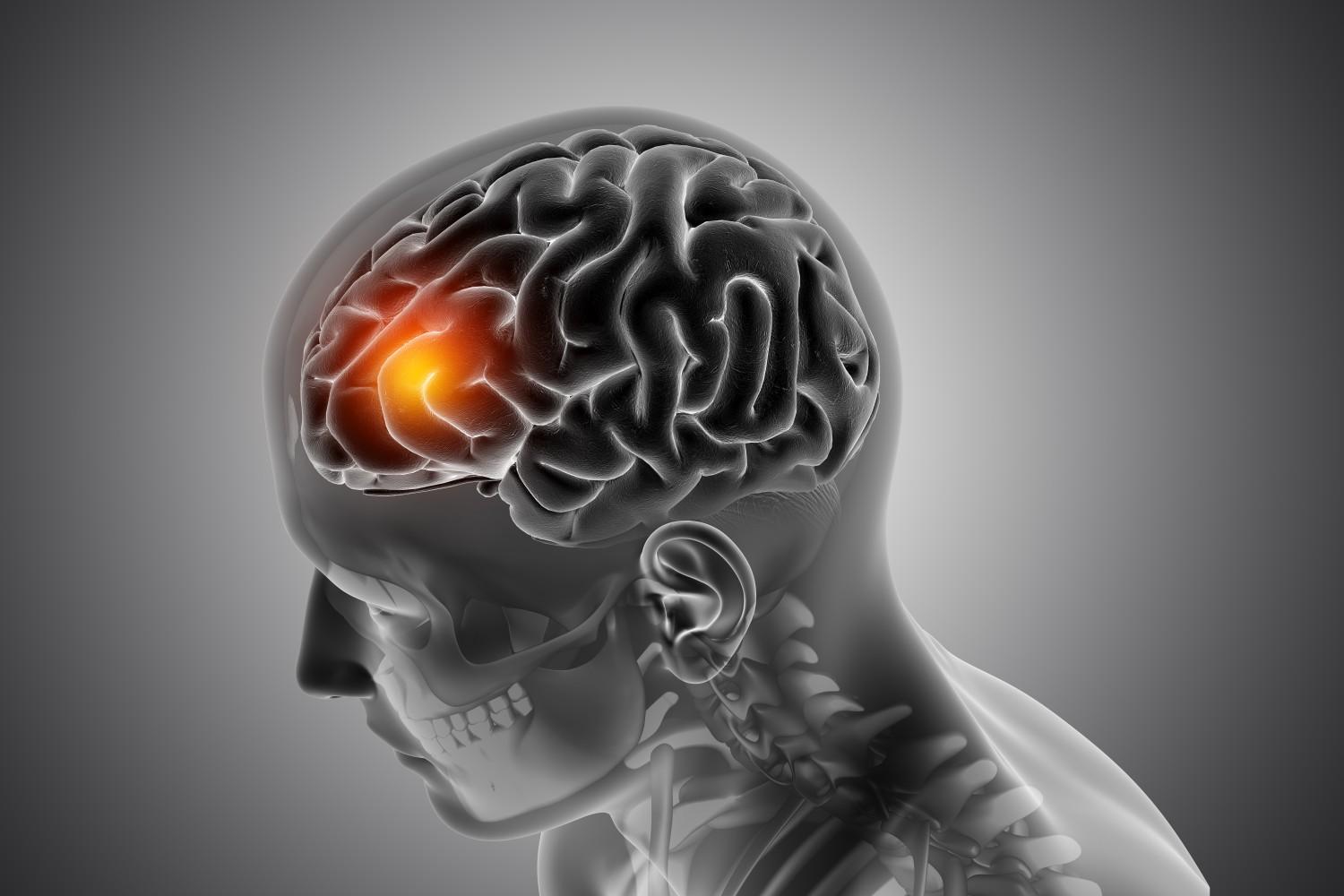 What are the Symptoms of a Brain Stroke and Its Treatment?