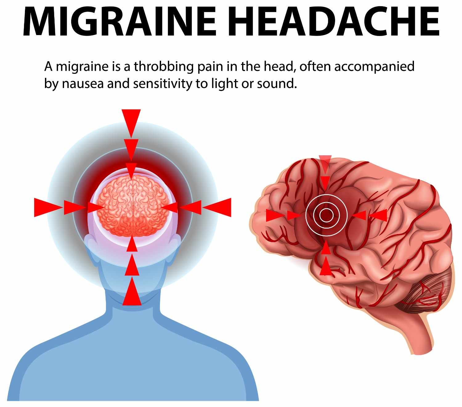 Migraine Headache: Causes, Symptoms, Types & Treatment Options